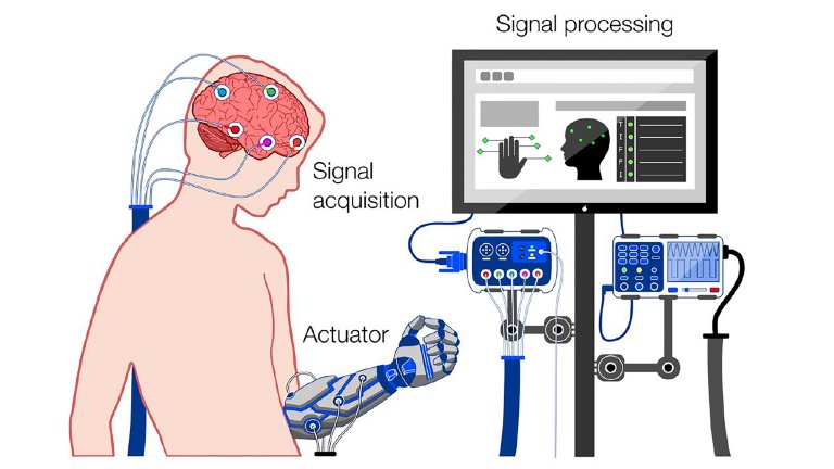 Neuralink vs Synchron: Comparativo das Interfaces Cérebro-Computador