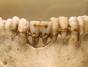 Quem Inventou O Aparelho Dental