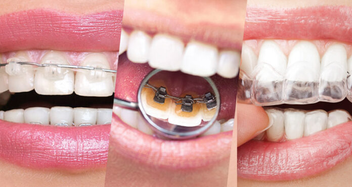 Quem Inventou O Aparelho Dental